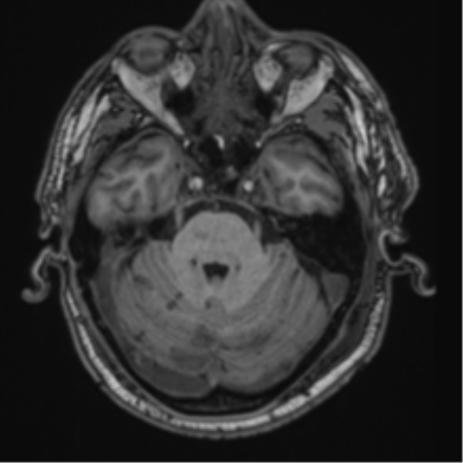 File:Blunt cerebrovascular injury (Radiopaedia 53682-59745 Axial T1 10).png