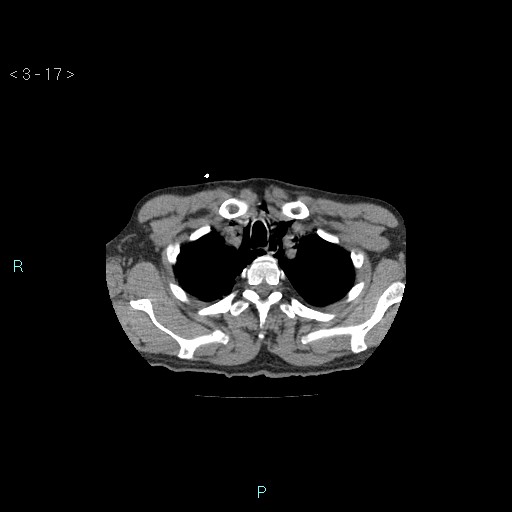 Boerhaave syndrome (Radiopaedia 27683-27897 Axial non-contrast 17).jpg