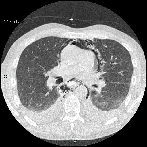 Boerhaave syndrome (Radiopaedia 27683-27897 lung window 33).jpg
