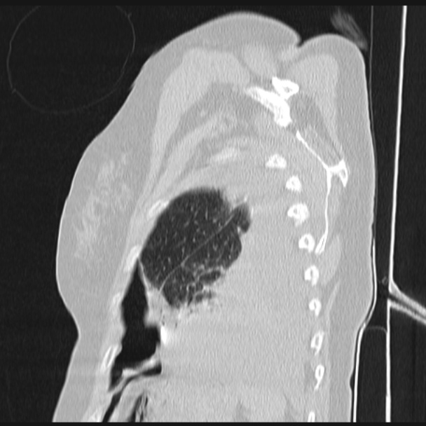 Boerhaave syndrome (Radiopaedia 45644-49799 Sagittal lung window 74).jpg