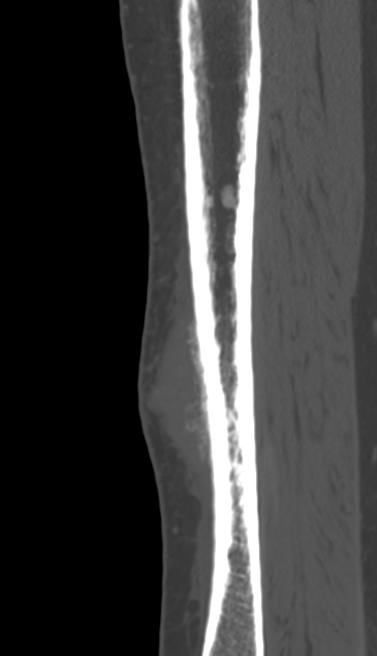 Bone metastasis - tibia (Radiopaedia 57665-64609 Sagittal bone window 59).jpg