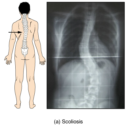File:Bones and ligaments of the vertebral column (illustrations) (Radiopaedia 42770-45935 None 14).jpg