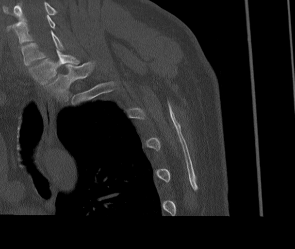 Bony Bankart and Hill-Sachs lesions (Radiopaedia 33622-34727 Sagittal bone window 73).png