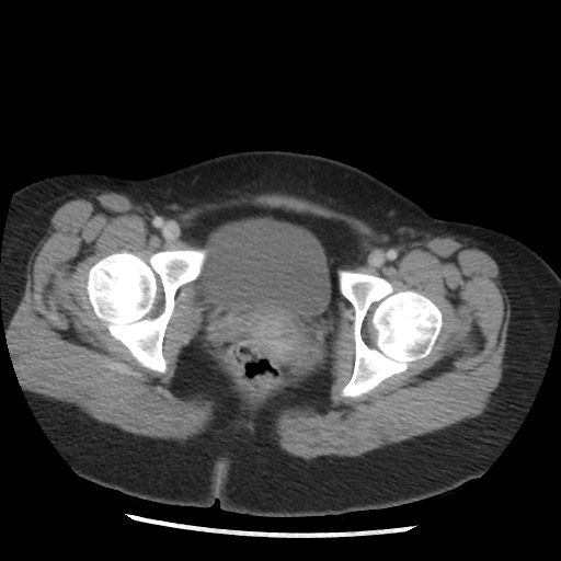 File:Borderline mucinous tumor (ovary) (Radiopaedia 78228-90808 A 135).jpg