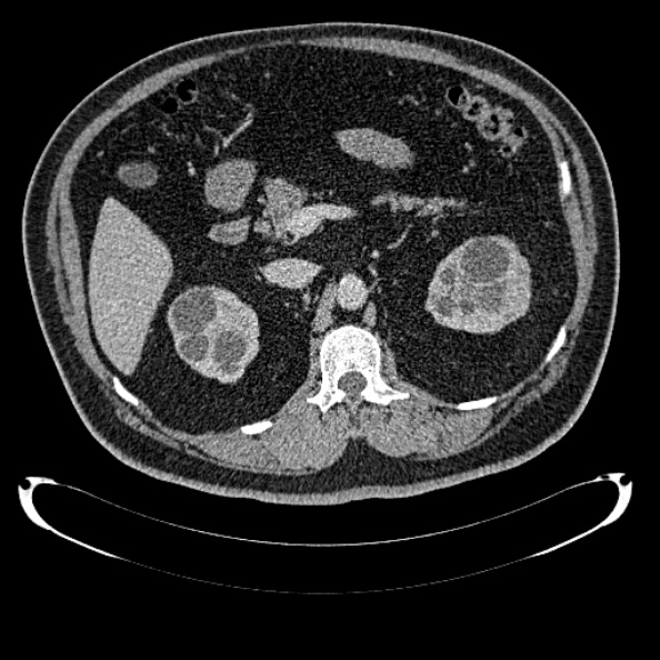 File:Bosniak renal cyst - type IV (Radiopaedia 24244-24518 C 117).jpg