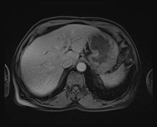 Bouveret syndrome (Radiopaedia 61017-68856 Axial T1 C+ fat sat 18).jpg