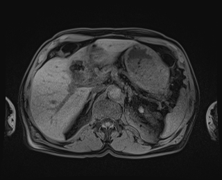 Bouveret syndrome (Radiopaedia 61017-68856 Axial T1 fat sat 26).jpg