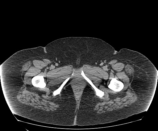 Bowel and splenic infarcts in acute lymphocytic leukemia (Radiopaedia 61055-68913 A 131).jpg