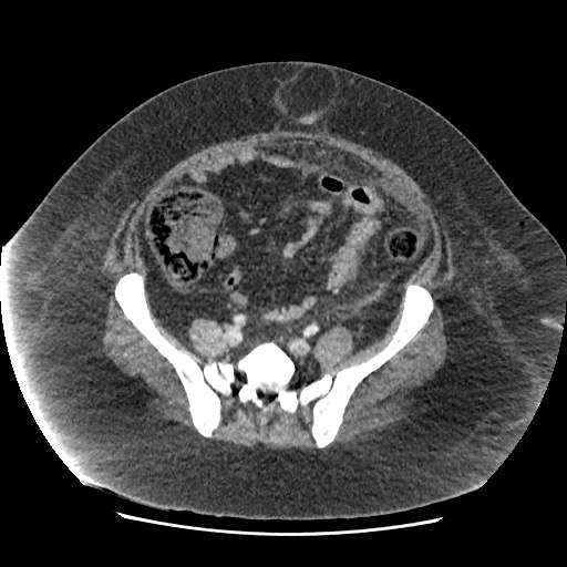 File:Bowel and splenic infarcts in acute lymphocytic leukemia (Radiopaedia 61055-68915 A 97).jpg