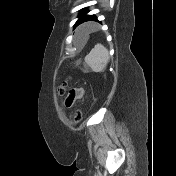 Bowel and splenic infarcts in acute lymphocytic leukemia (Radiopaedia 61055-68915 C 15).jpg