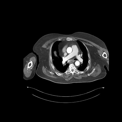 File:Bowel ischemia secondary to SMA occlusion with extensive portomesenteric venous gas (Radiopaedia 54656-60871 A 83).jpg