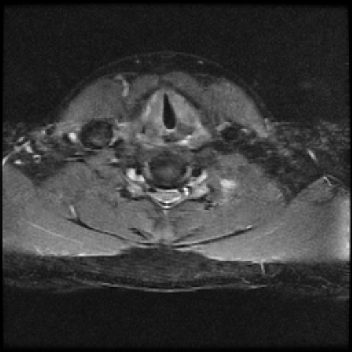 File:Brachial plexus neurofibroma (Radiopaedia 28030-28291 Axial STIR 1).png