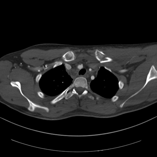 Brachiocephalic trunk pseudoaneurysm (Radiopaedia 70978-81191 Axial bone window 54).jpg