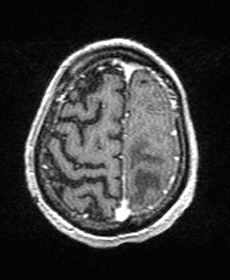 Brain abscess with dual rim sign (Radiopaedia 87566-103938 Axial T1 C+ 135).jpg