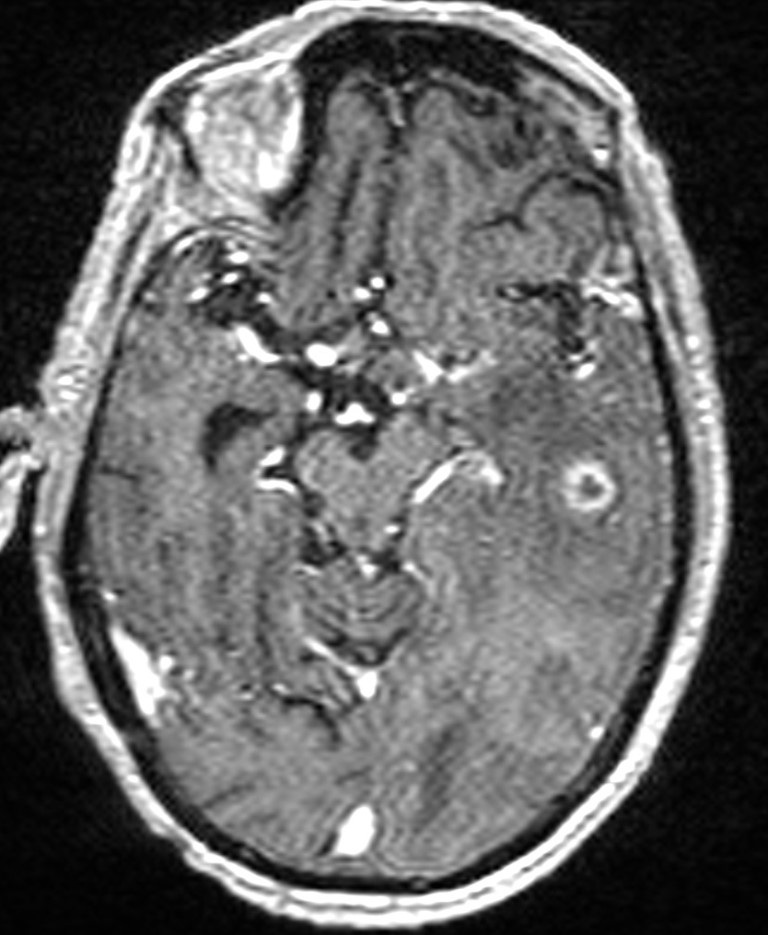 Brain abscess with dual rim sign (Radiopaedia 87566-103938 Axial T1 C+ 69).jpg