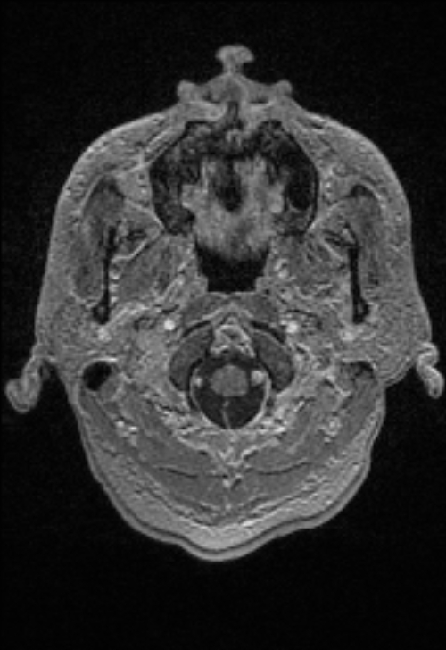 Brain abscess with ventriculitis (Radiopaedia 85703-101495 Axial T1 C+ 16).jpg