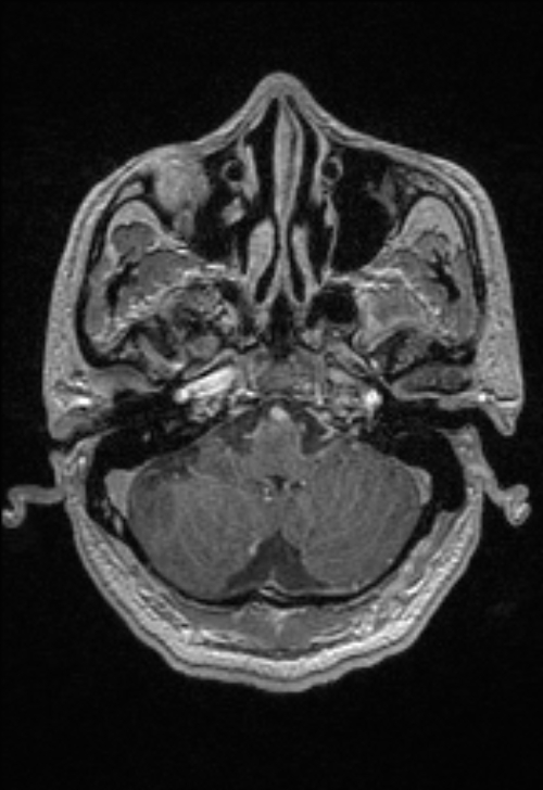 Brain abscess with ventriculitis (Radiopaedia 85703-101495 Axial T1 C+ 40).jpg