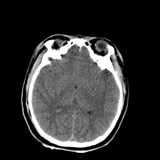 File:Brain contusions, internal carotid artery dissection and base of skull fracture (Radiopaedia 34089-35339 Axial non-contrast 29).png
