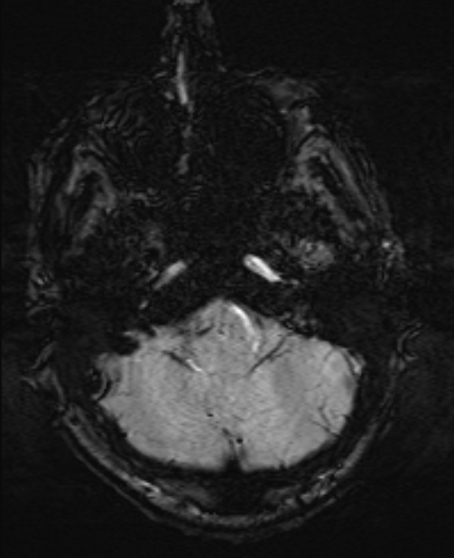 Brain metastases - lung cancer primary (Radiopaedia 75060-86115 Axial SWI 12).jpg