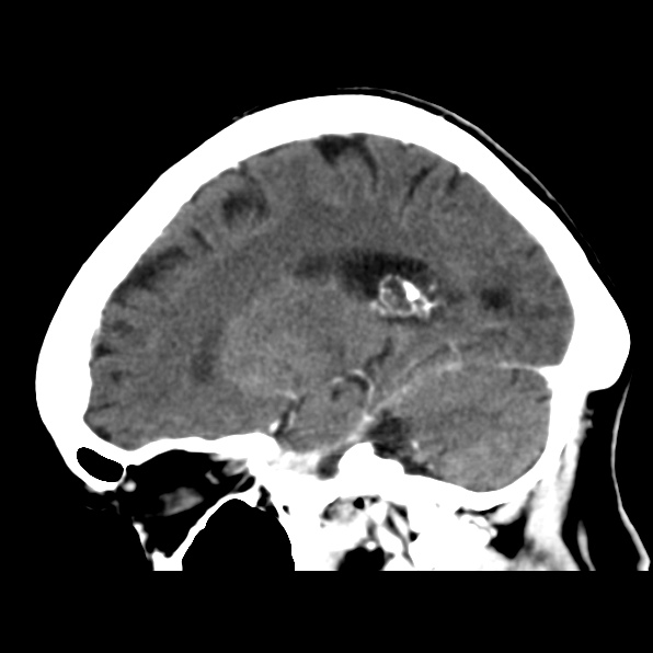 File:Brain metastases from breast cancer (Radiopaedia 23178-23231 C 31).jpg