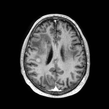 File:Brain metastases from lung cancer (Radiopaedia 83839-99028 Axial T1 C+ 43).jpg