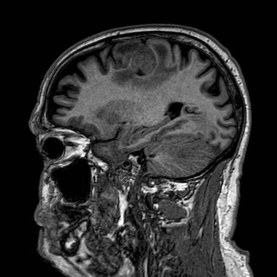Brain metastases from lung cancer (Radiopaedia 83839-99028 Sagittal T1 88).jpg