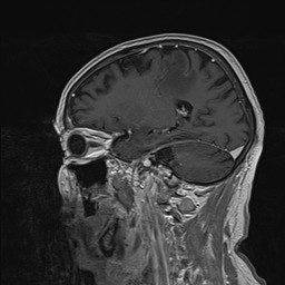 Brain metastasis (Radiopaedia 42617-45761 Sagittal T1 C+ 34).jpg