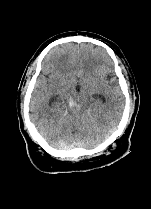 Brainstem hemorrhage (Radiopaedia 81294-94976 Axial non-contrast 38).jpg