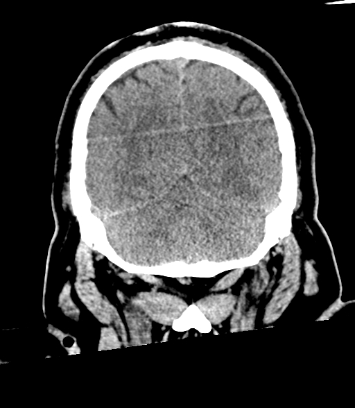 Brainstem hemorrhage (Radiopaedia 81294-94976 Coronal non-contrast 54).jpg