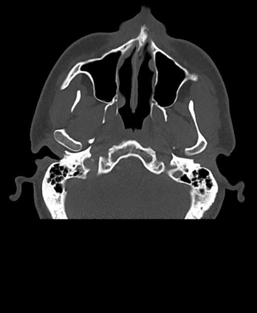 Branchial cleft cyst (Radiopaedia 31167-31875 Axial bone window 10).jpg