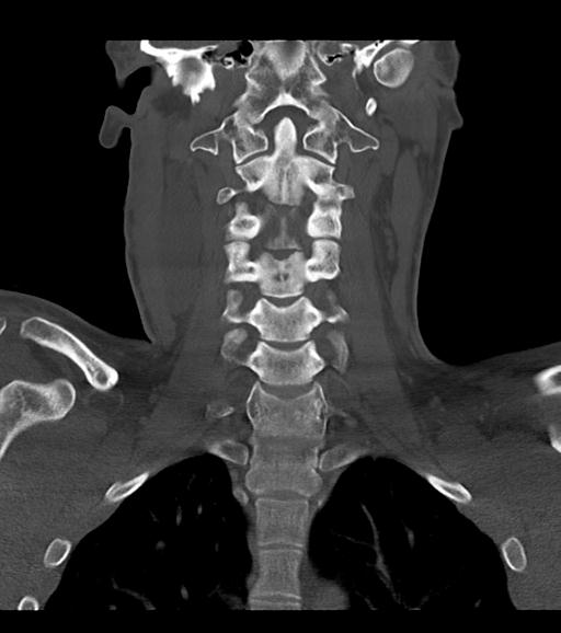Branchial cleft cyst (Radiopaedia 31167-31875 Coronal bone window 40).jpg
