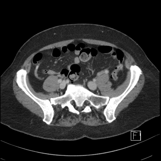 File:Breast metastases from renal cell cancer (Radiopaedia 79220-92225 C 82).jpg