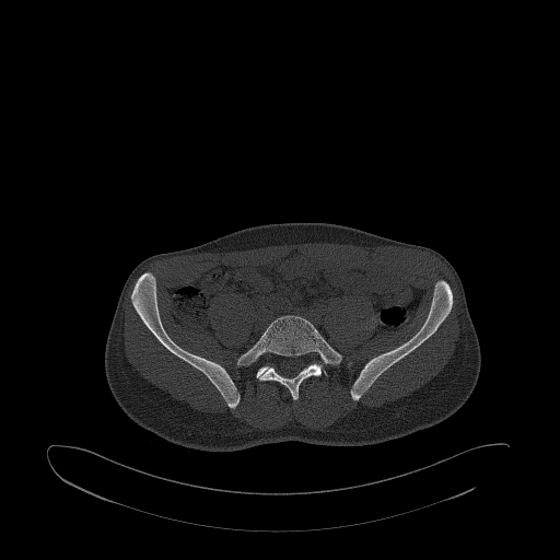 Brodie abscess- femoral neck (Radiopaedia 53862-59966 Axial bone window 10).jpg
