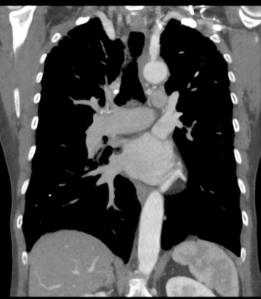 Bronchial artery aneurysms (Radiopaedia 42282-45385 Coronal C+ delayed 37).png
