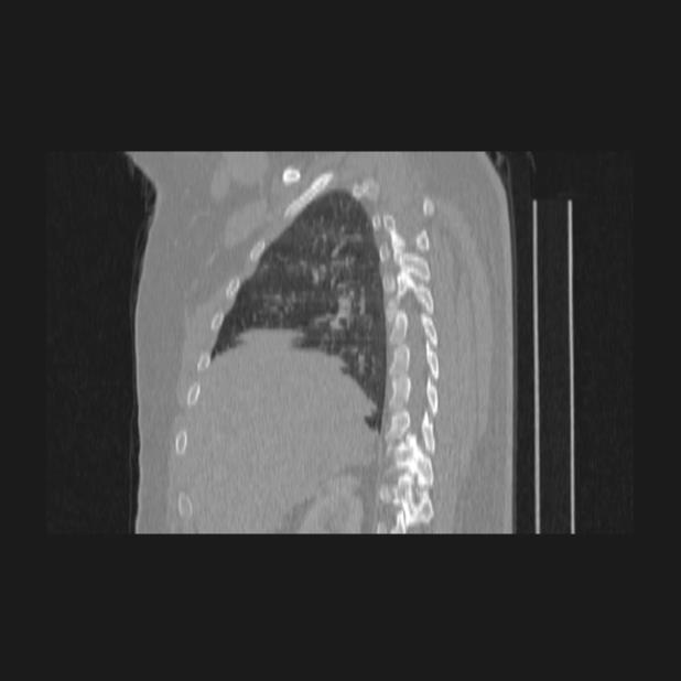 Bronchial atresia (Radiopaedia 60685-68439 Sagittal lung window 25).jpg
