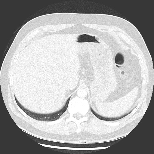 Bronchial carcinoid tumor (Radiopaedia 67377-76764 Axial lung window 56).jpg