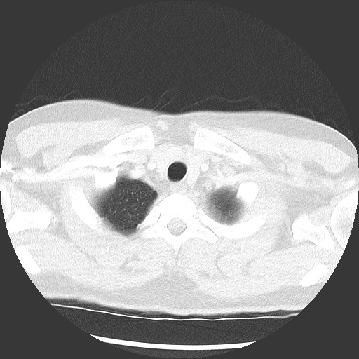 Bronchial carcinoid tumor (Radiopaedia 67377-76764 Axial lung window 9).jpg