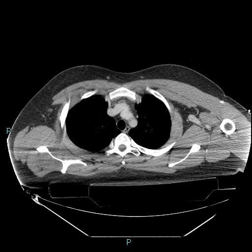 Bronchial carcinoid tumor (Radiopaedia 78272-90870 C 33).jpg