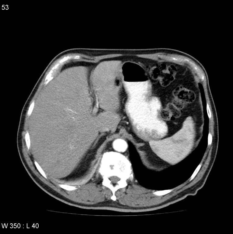 Bronchial carcinoid tumor with right lower lobe collapse (Radiopaedia 29060-29422 A 52).jpg
