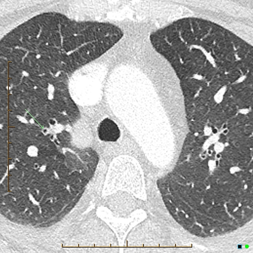 File:Bronchial diverticula (Radiopaedia 79512-92677 Axial lung window 1).jpg
