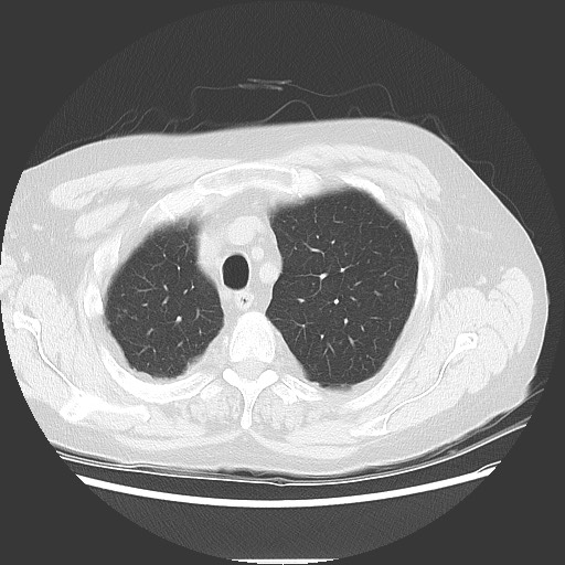 Bronchial stenosis - lung transplant (Radiopaedia 73133-83848 Axial lung window 14).jpg