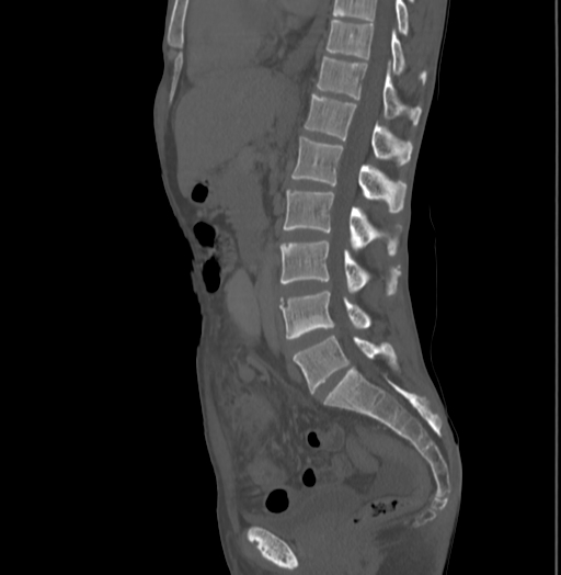 File:Bronchiectasis in Crohn disease (Radiopaedia 60311-67977 Sagittal bone window 126).jpg