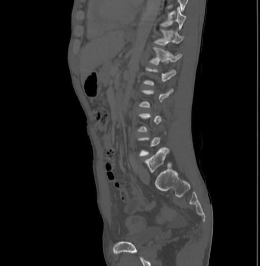 File:Bronchiectasis in Crohn disease (Radiopaedia 60311-67977 Sagittal bone window 151).jpg