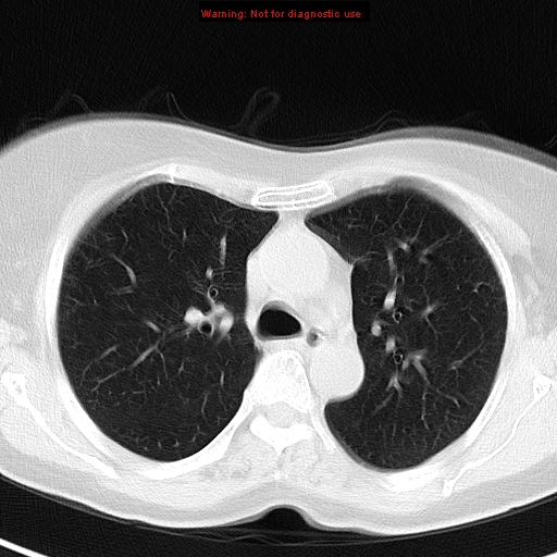 File:Bronchoalveolar carcinoma (BAC) (Radiopaedia 13436-13392 Axial lung window 18).jpg
