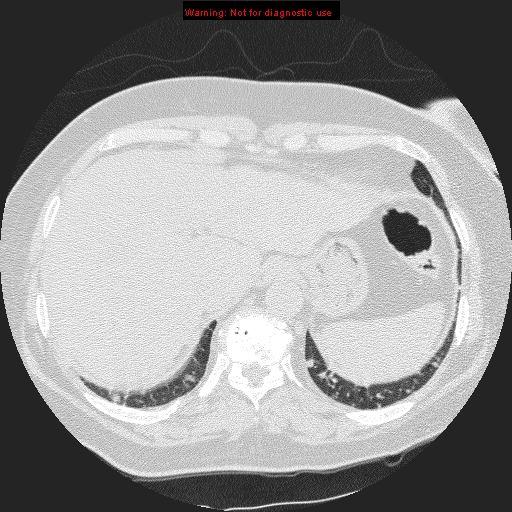 File:Bronchoalveolar carcinoma (Radiopaedia 13224-13233 B 9).jpg