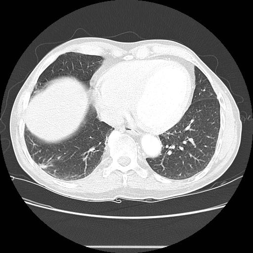 Bronchocele (Radiopaedia 17097-16795 Axial lung window 86).jpg