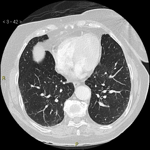 Bronchogenic carcinoma as an incidental finding (Radiopaedia 16453-16130 Axial lung window 42).jpg