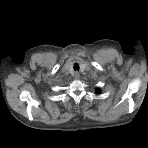 Bronchogenic carcinoma with metastatic lymphadenopathy (Radiopaedia 37671-39569 Axial non-contrast 4).jpg
