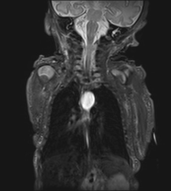 File:Bronchogenic cyst (Radiopaedia 27207-27380 Coronal STIR 7).jpg