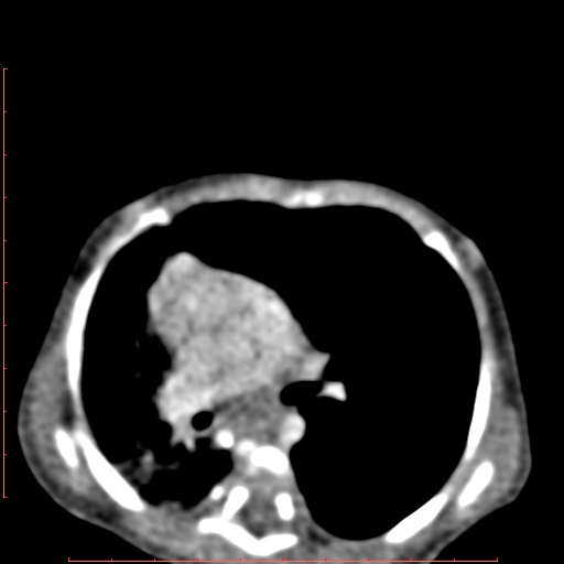 Bronchogenic cyst (Radiopaedia 78599-91409 B 100).jpg